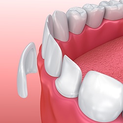 Animation of porcelain veneer placement