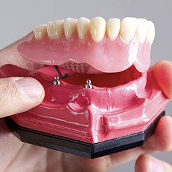 Model of implant supported denture