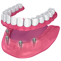 Animation of All-on-4 dentures