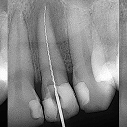 X-rays fo root canal treated tooth