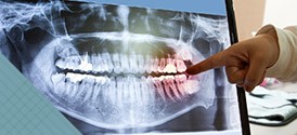 Panoramic dental x-rays on computer